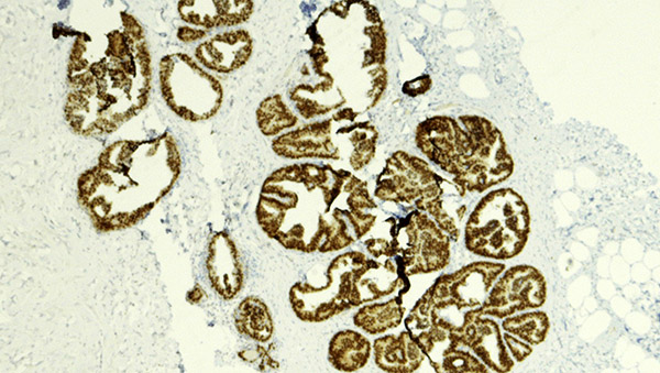 Cellular image DCIS
